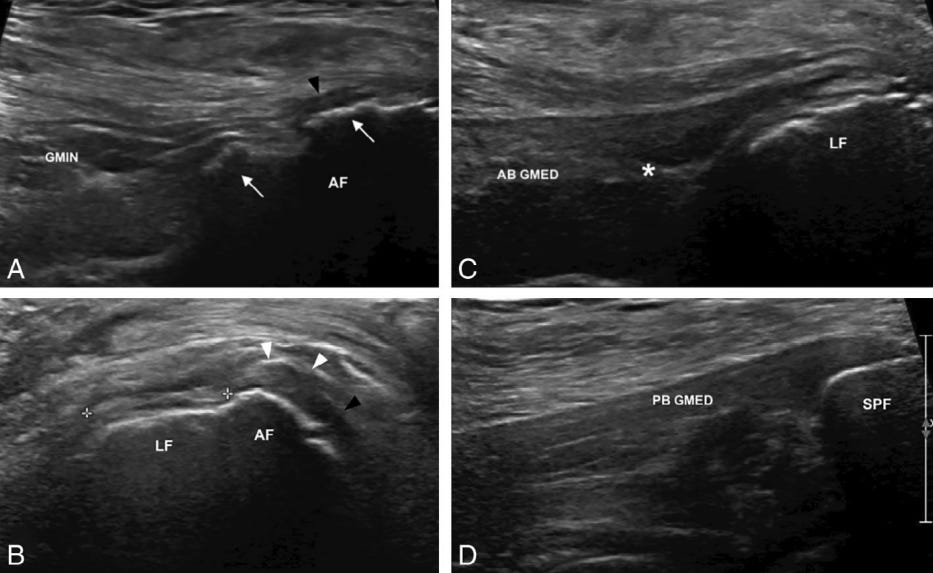 Gluteo menor 6 ecografia tempo formacion.jpg